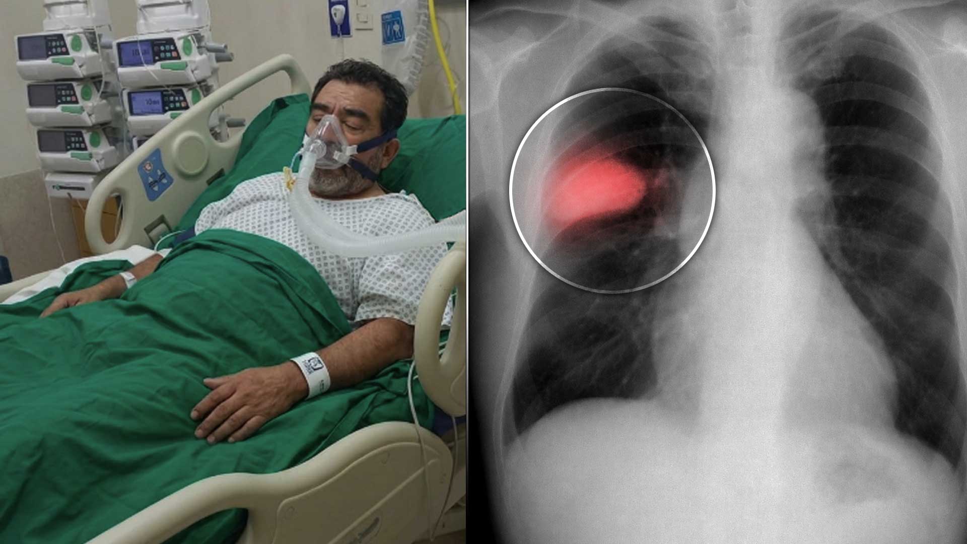 3 cosas que reducen el riesgo de varios tipos de cáncer, según oncólogos