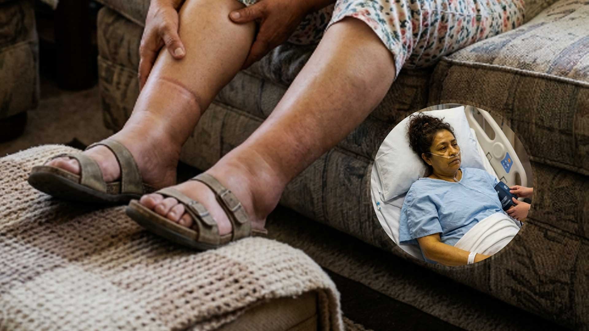3 síntomas de que tu hígado está fallando
