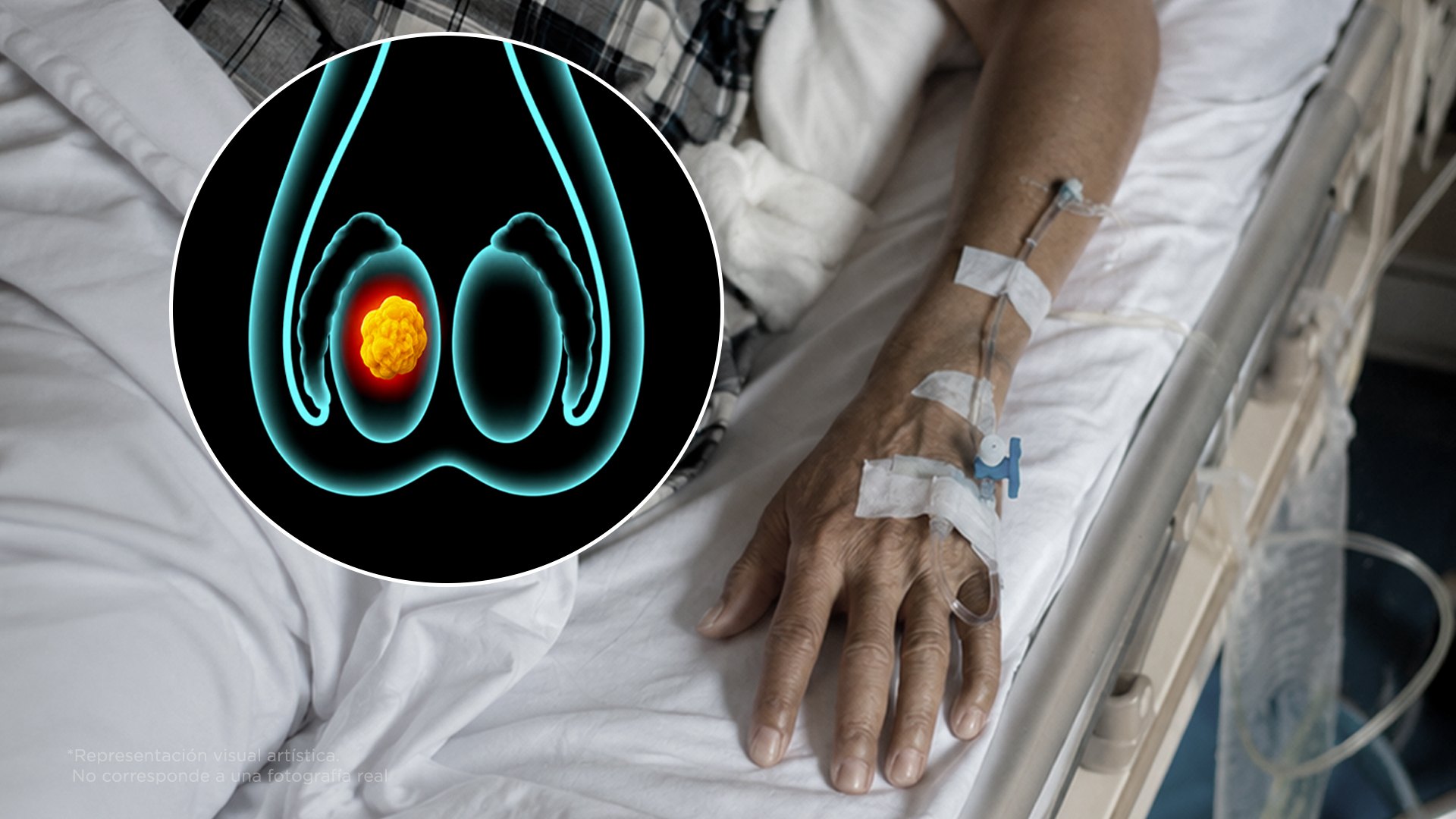 Le salió una bolita y no fue al doctor. 1 año después falleció