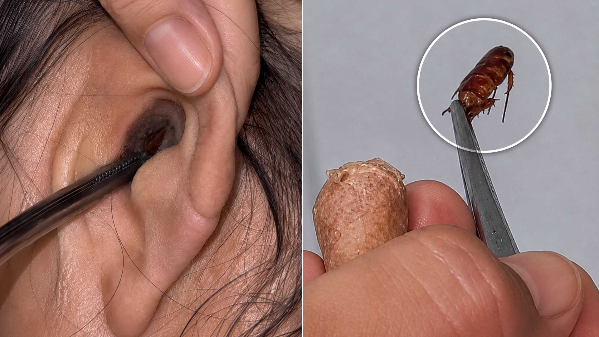 Lo que nunca debes hacer si una cucaracha se te mete al oído