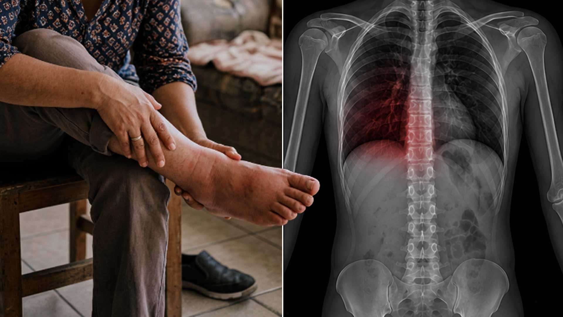 Meses antes de un paro cardíaco tus pies se empiezan a hinchar