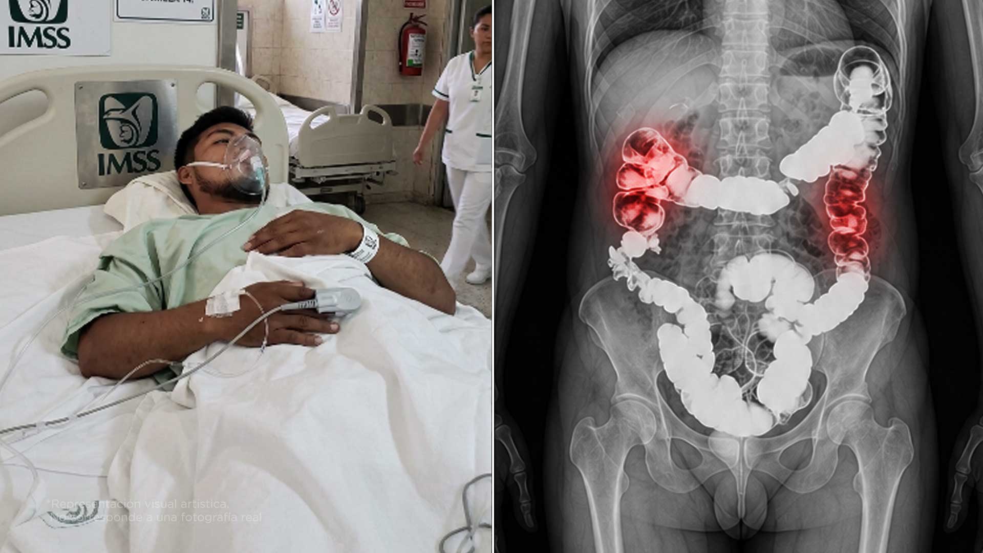¿Por qué cada vez más jóvenes tienen cáncer de colon?