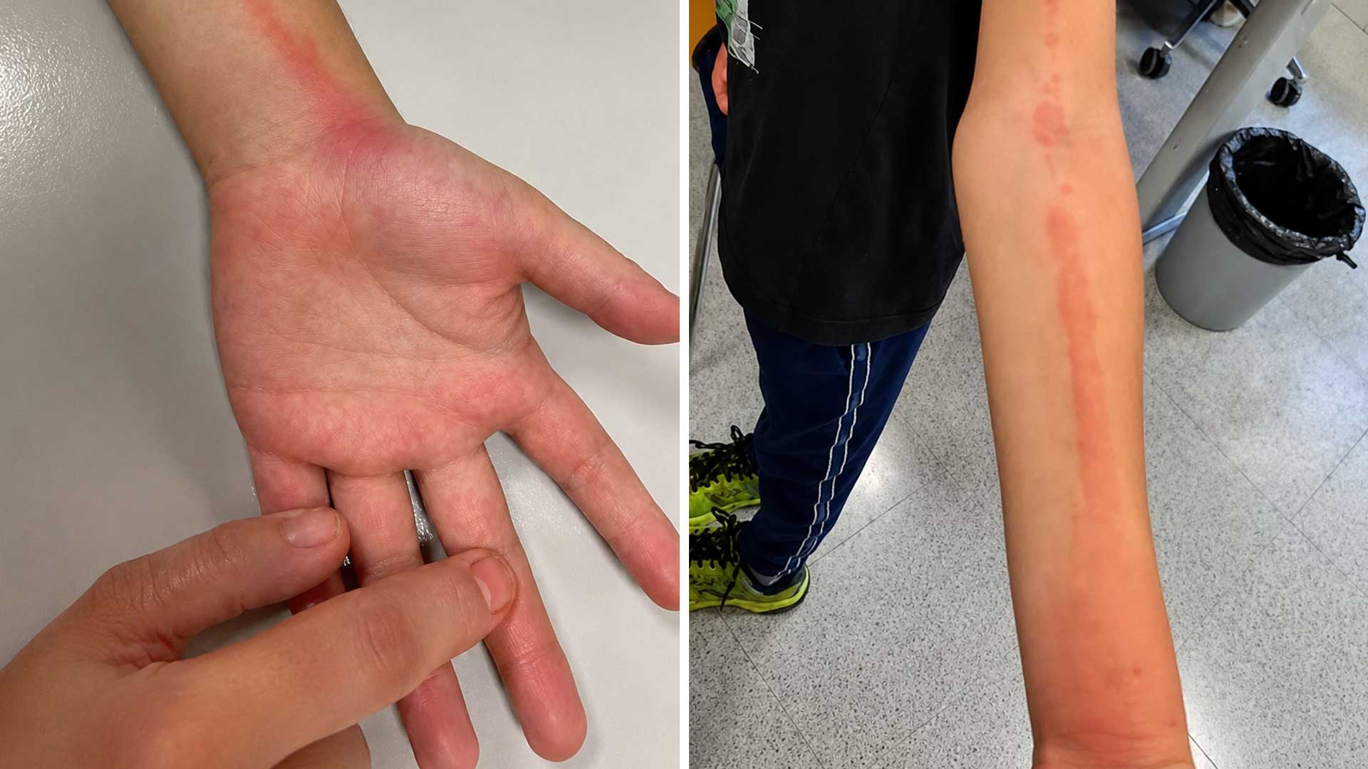 Si ves esta línea roja en tu hijo, ve al médico el mismo día